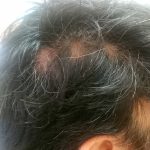 脱毛症の種類について